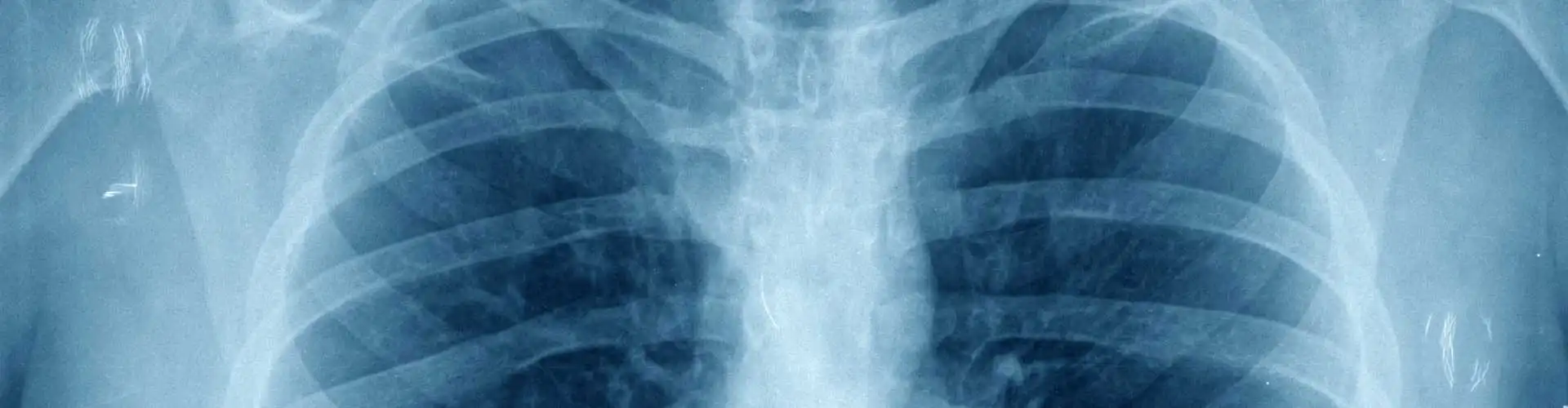 Allergy Relief Through Chiropractic Care in Fishers: Strengthening Your Immune Response Naturally